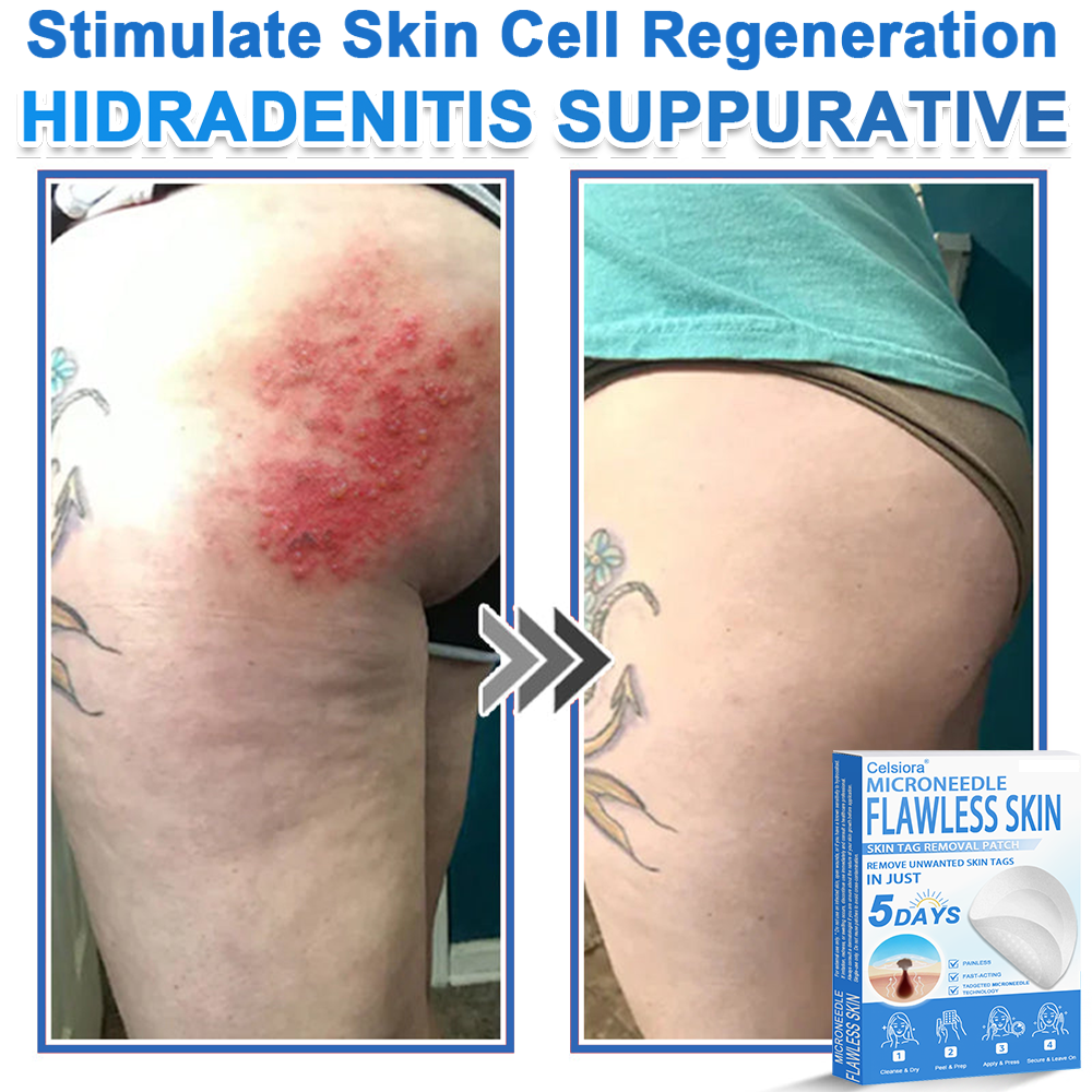 ✅Keepfity® 2-in-1 Microneedle & Hydrocolloid Patch | Raised Moles,Acne,  Flat Warts & Skin Tags Remover | Improves Wrinkles, Scars & Blemishes | Invisible Pimple Patches for Face & Body