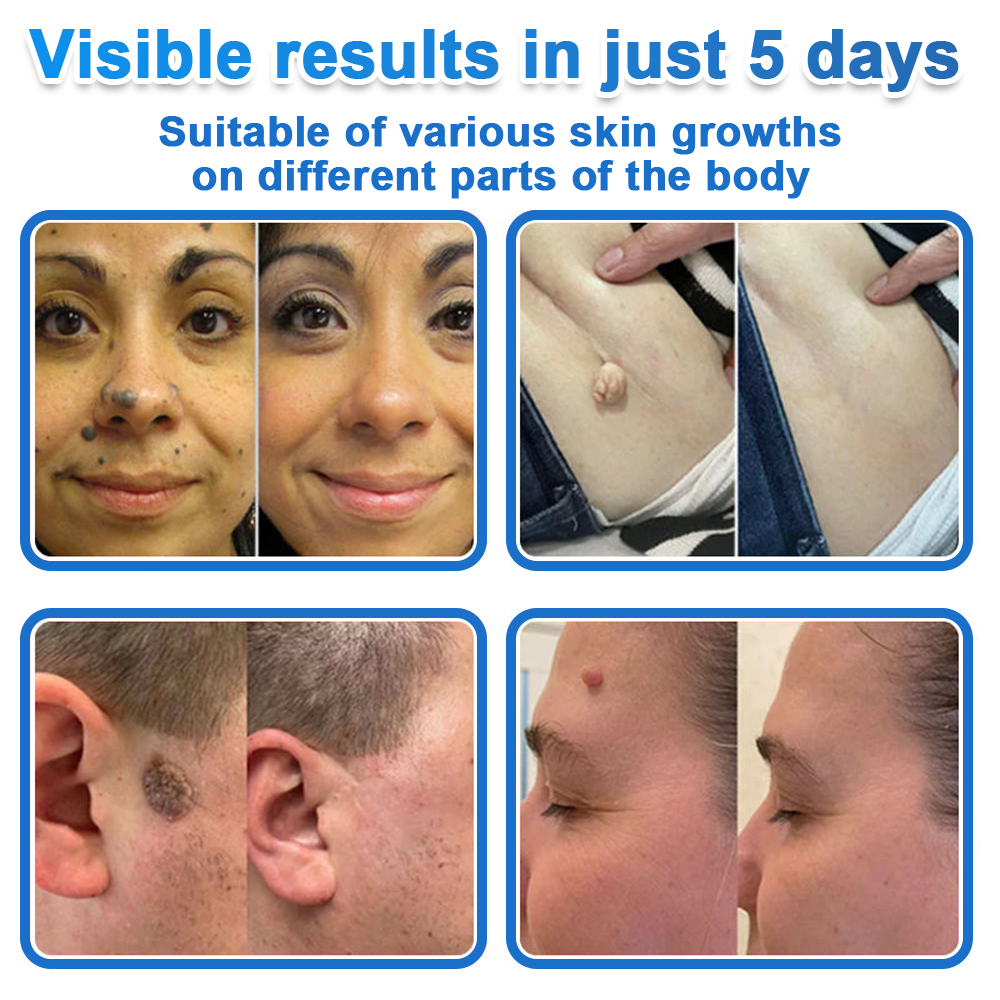 ✅Keepfity® 2-in-1 Microneedle & Hydrocolloid Patch | Raised Moles,Acne,  Flat Warts & Skin Tags Remover | Improves Wrinkles, Scars & Blemishes | Invisible Pimple Patches for Face & Body