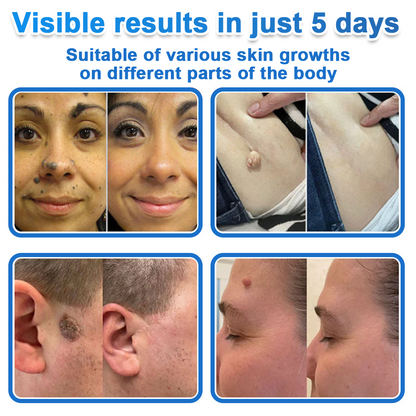 ✅Keepfity® 2-in-1 Microneedle & Hydrocolloid Patch | Raised Moles,Acne,  Flat Warts & Skin Tags Remover | Improves Wrinkles, Scars & Blemishes | Invisible Pimple Patches for Face & Body