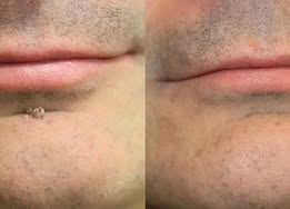 ✨Keepfity® 2-in-1 Microneedle & Hydrocolloid Patch🍀| Removes Raised Moles, Acne, Flat Warts & Skin Tags | Helps Improve Wrinkles, Scars & Blemishes | Invisible Patches for Face & Body