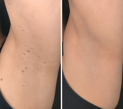 ✨Keepfity® 2-in-1 Microneedle & Hydrocolloid Patch🍀| Removes Raised Moles, Acne, Flat Warts & Skin Tags | Helps Improve Wrinkles, Scars & Blemishes | Invisible Patches for Face & Body