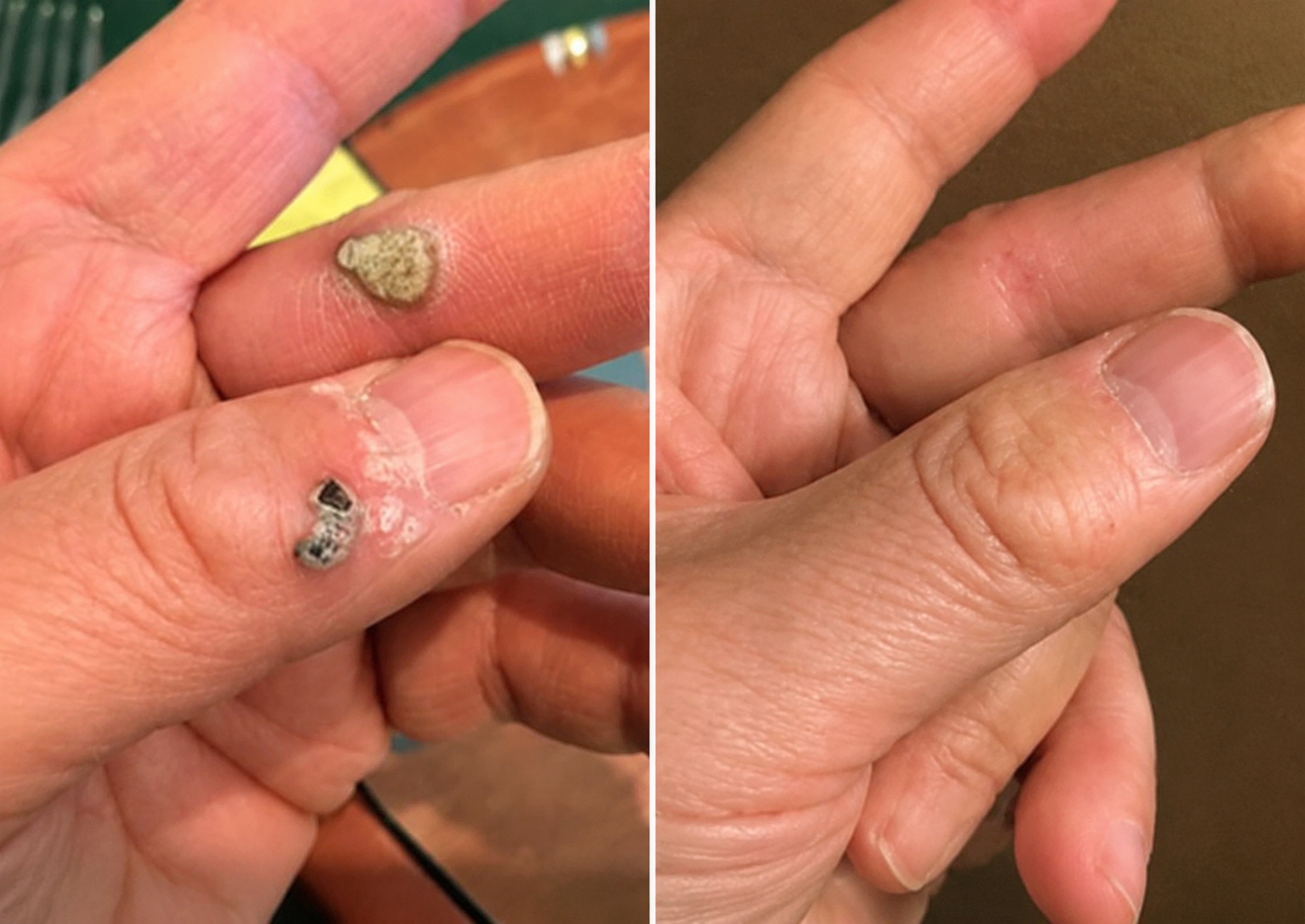 ✨Keepfity® 2-in-1 Microneedle & Hydrocolloid Patch🍀| Removes Raised Moles, Acne, Flat Warts & Skin Tags | Helps Improve Wrinkles, Scars & Blemishes | Invisible Patches for Face & Body